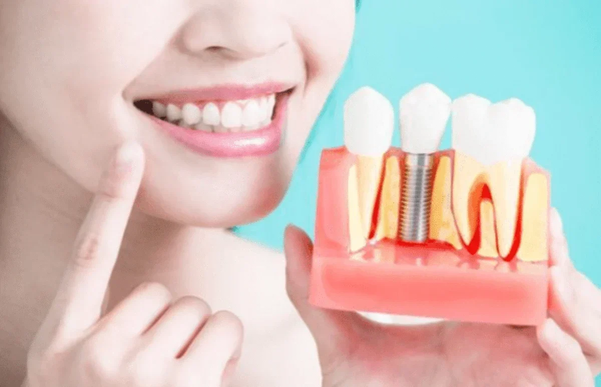 Cat Dureaza un Implant Dentar? 23 Cat Dureaza un Implant Dentar? – ProDent Dr. Gruia