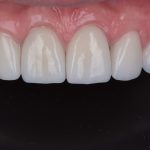 cost fatete dentare