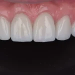 Cat costa fatetele dentare?