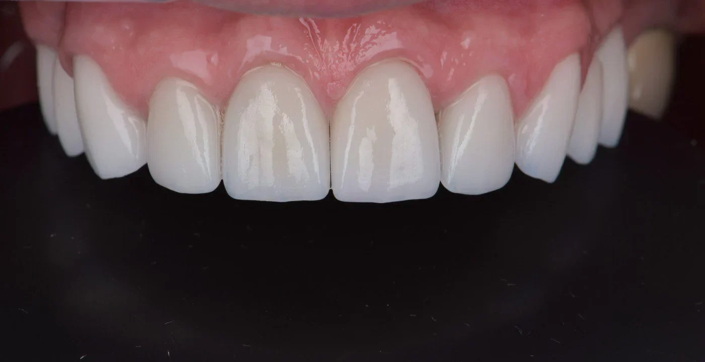 Cat costa fatetele dentare?