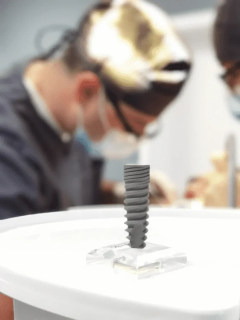 Când este nevoie de un implant dentar: Lucrurile pe care trebuie să le știți 19 Când este nevoie de un implant dentar: Lucrurile pe care trebuie să le știți