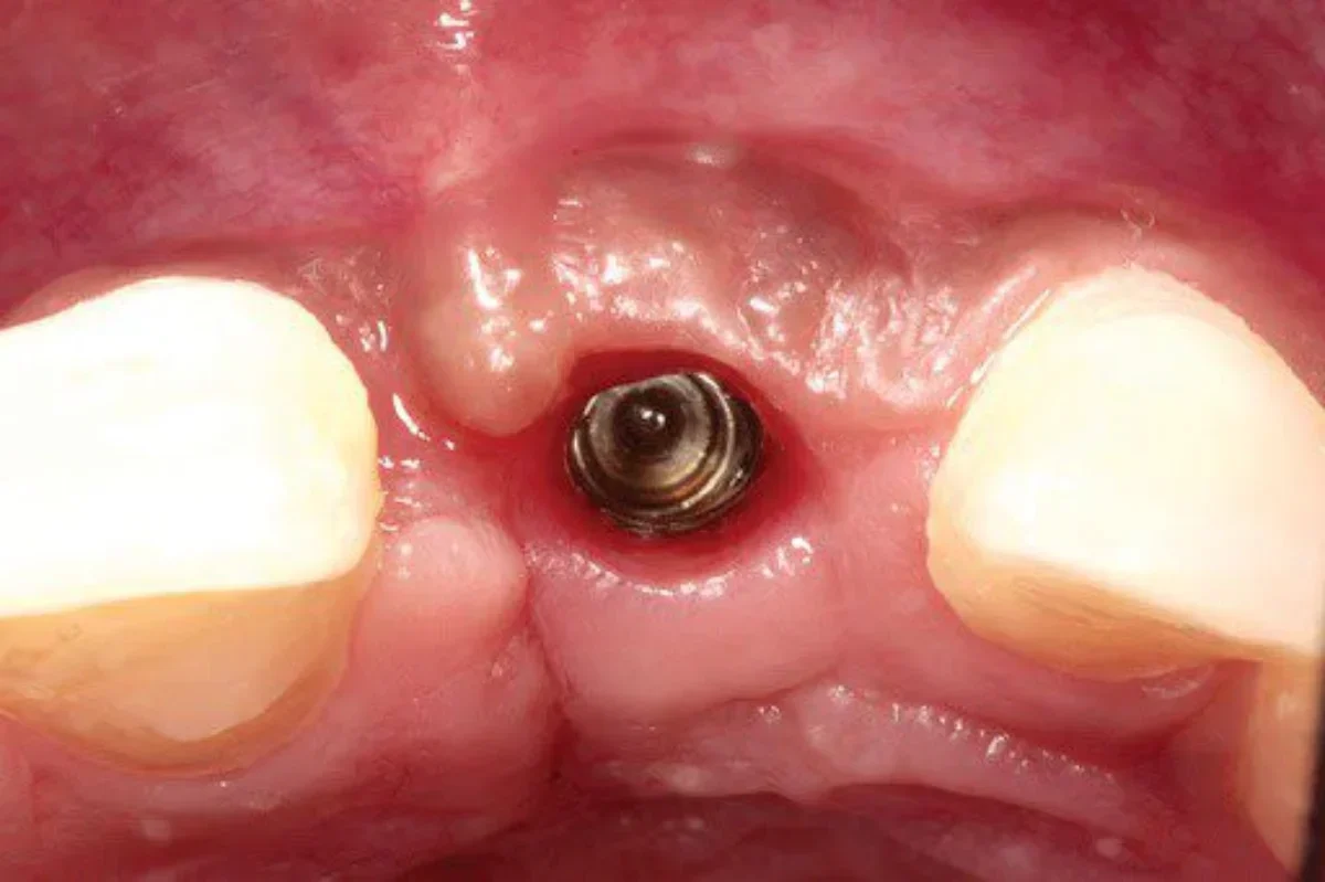 In cât timp se vindecă gingia după implant? 22 In cât timp se vindecă gingia după implant?