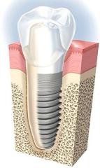 Implant dentar- Informații utile