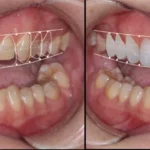 Cum se pun Fatetele Dentare?