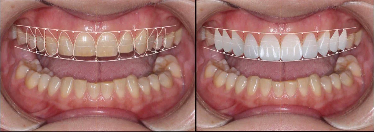 Cum se pun Fatetele Dentare?