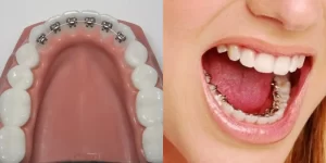 Aparatul dentar fix bucuresti
