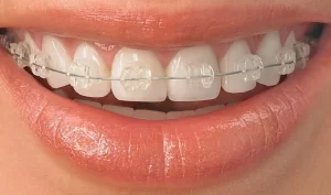 Aparatul dentar fix metalic