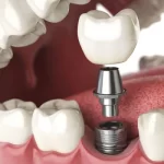 Cum să periezi corect dinții după un implant dentar