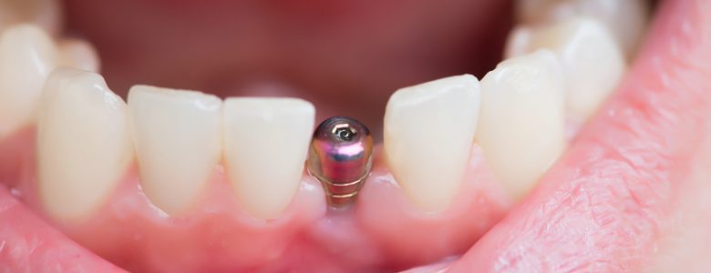 Ce trebuie sa stiti despre implanturile dentare inainte de a le alege