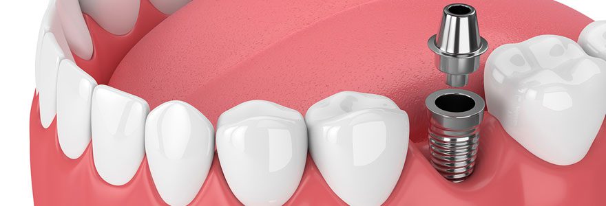 Implanturile dentare: cum functioneaza si care sunt avantajele lor