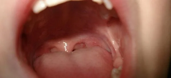 Halena (halitoza) sau respirația urât mirositoare 6 Halena (halitoza) sau respirația urât mirositoare