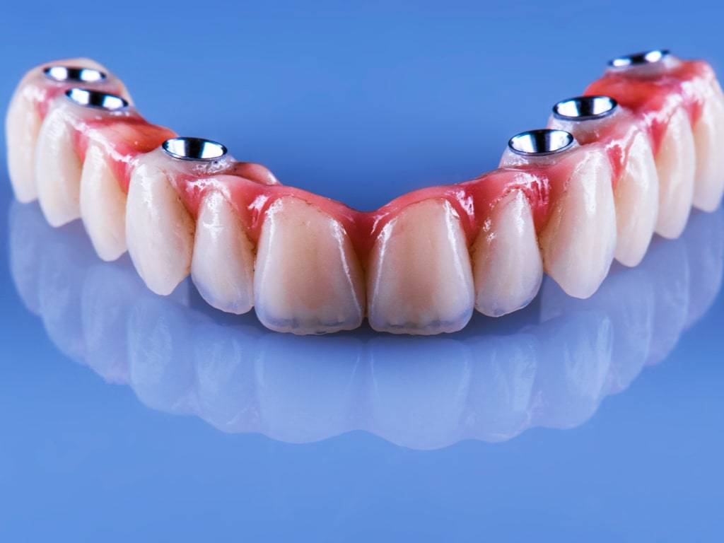 Proteza fixa cu 4 sau 6 implanturi dentare