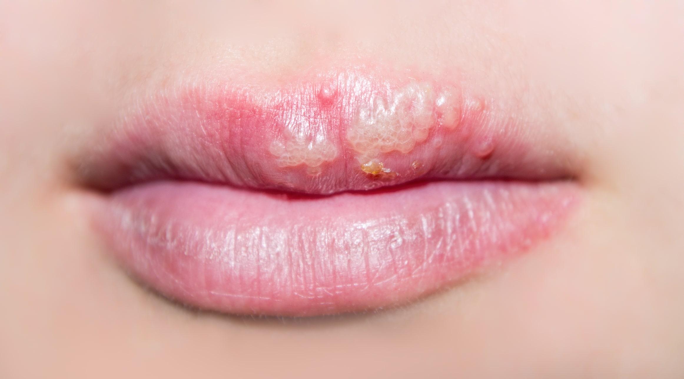 Medic stomatolog examinează o leziune provocată de herpes bucal în timpul consultației.