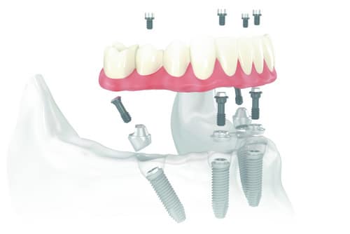 costul unui implant dentar prodent drgruia bucuresti