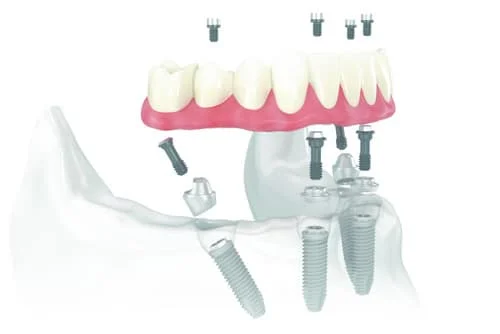 Cat costa un implant dentar – Pret etape si plan de tratament