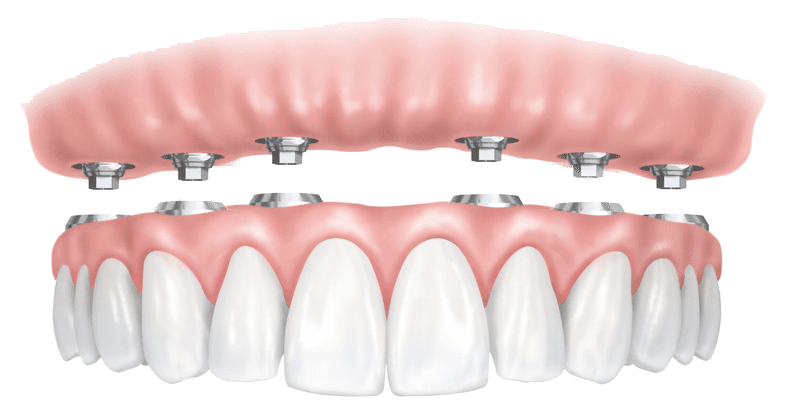 proteza dentara cu capse