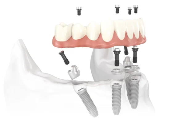 All-On-4/All-On-6 Sisteme de Implant Dentar