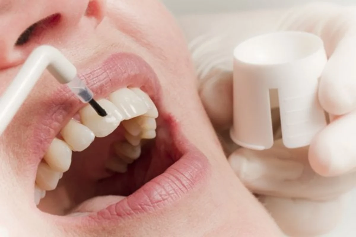 fluorizare dentara