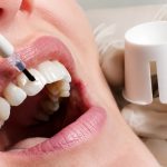 Fluorizarea dinților la Clinica Stomatologică Prodent Dr. Gruia din Câmpina