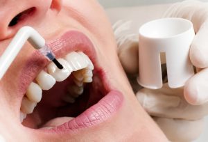 Fluorizarea dinților la Clinica Stomatologică Prodent Dr. Gruia din Câmpina