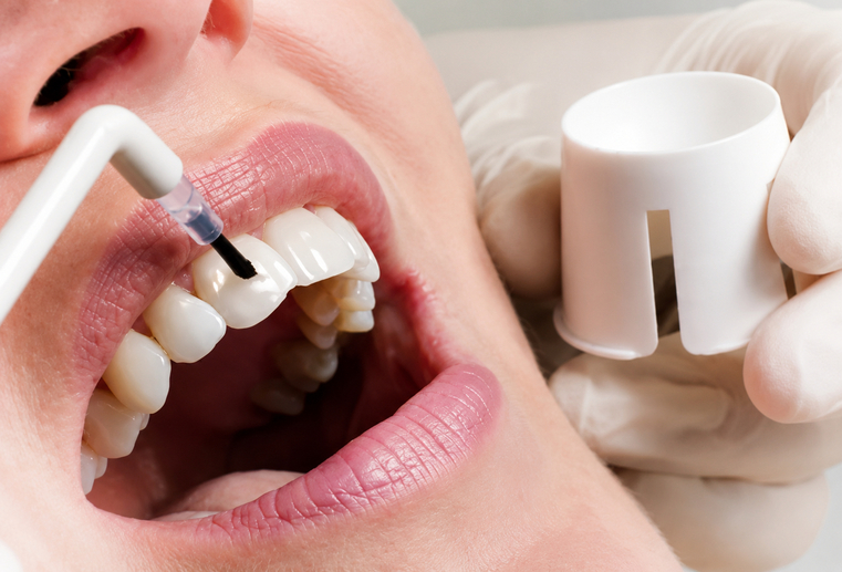 Fluorizarea dinților la Clinica Stomatologică Prodent Dr. Gruia din Câmpina