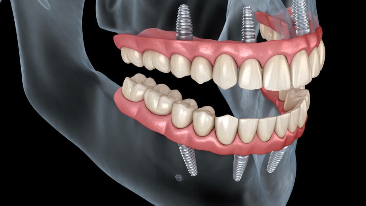 implant dentar bucuresti