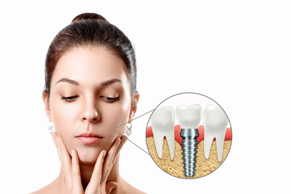 Recuperare după implant dentar 1