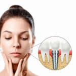 Recuperare după implant dentar 1