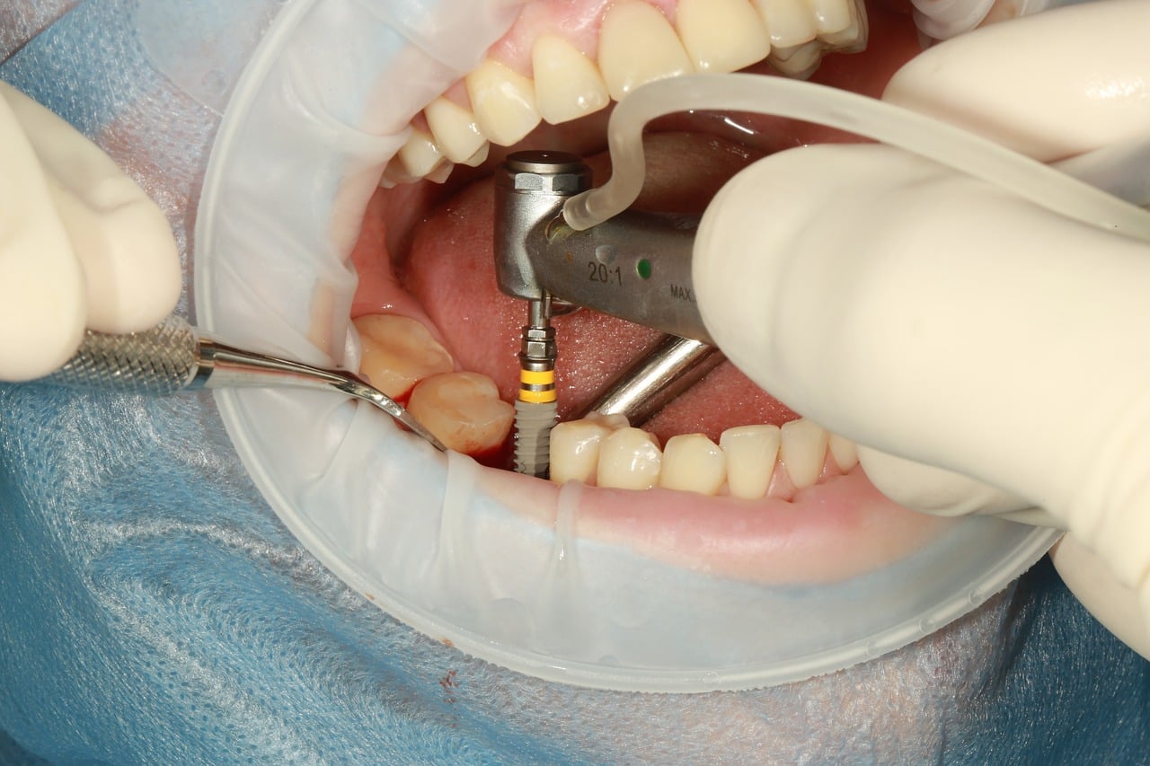 simptome după implant dentar