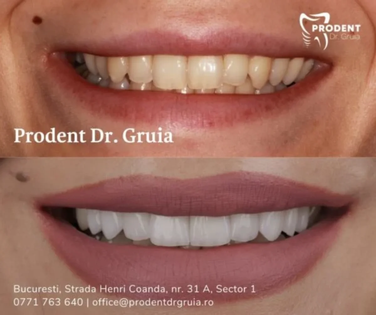 Fatete dentare • Tipuri, pret, avantaje si dezavantaje – ProDent Dr. Gruia