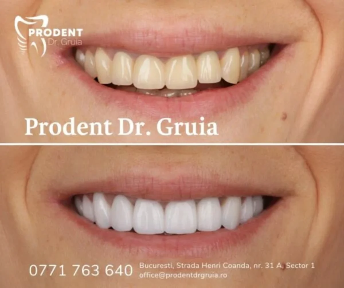 Fatete dentare • Tipuri, pret, avantaje si dezavantaje – ProDent Dr. Gruia