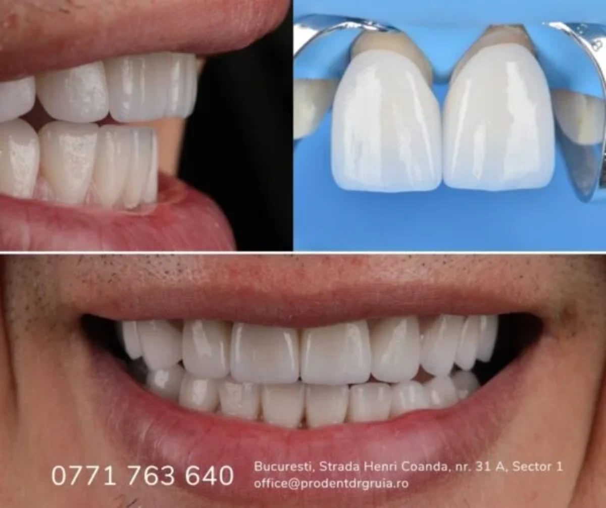 Fatete dentare • Tipuri, pret, avantaje si dezavantaje – ProDent Dr. Gruia