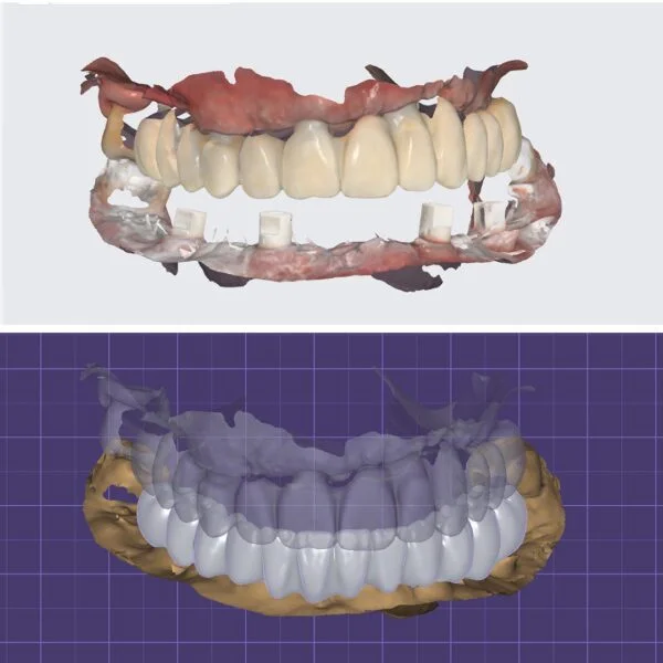 Proteza fixa pe implanturi - All on 4 / All on 6