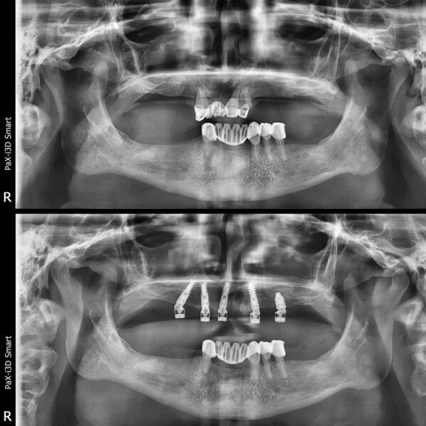 Proteza fixa pe implanturi - All on 4 / All on 6