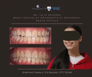 caz ortodontie Corecție dantură - Prodent Dr Gruia