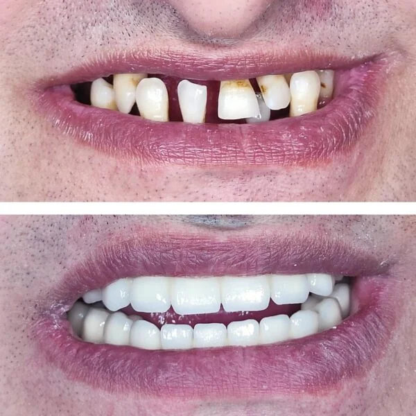 Proteza fixa pe implanturi - All on 4 / All on 6