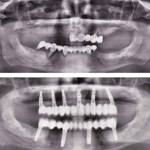 Proteza fixa pe implanturi - All on 4 / All on 6