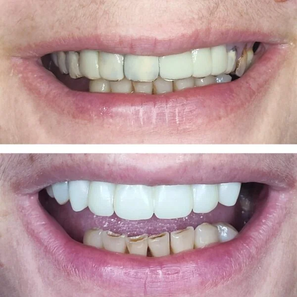 Proteza fixa pe implanturi - All on 4 / All on 6