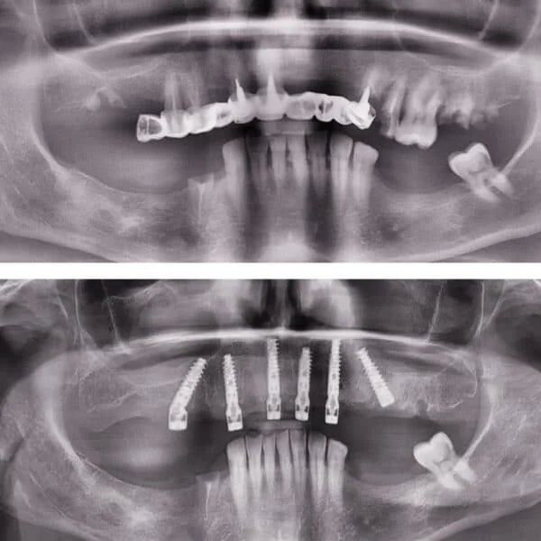 Proteza fixa pe implanturi - All on 4 / All on 6