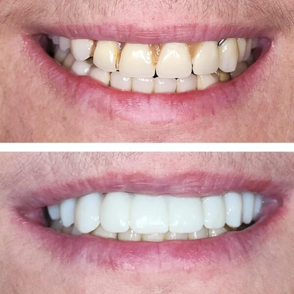 Proteza fixa pe implanturi - All on 4 / All on 6