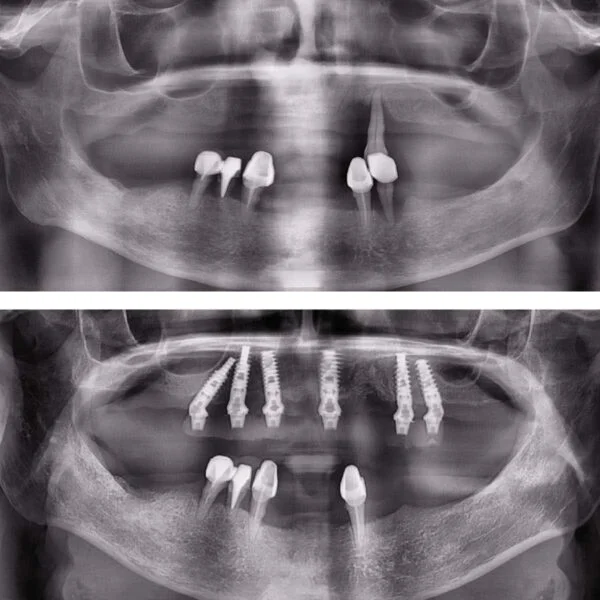 Proteza fixa pe implanturi - All on 4 / All on 6