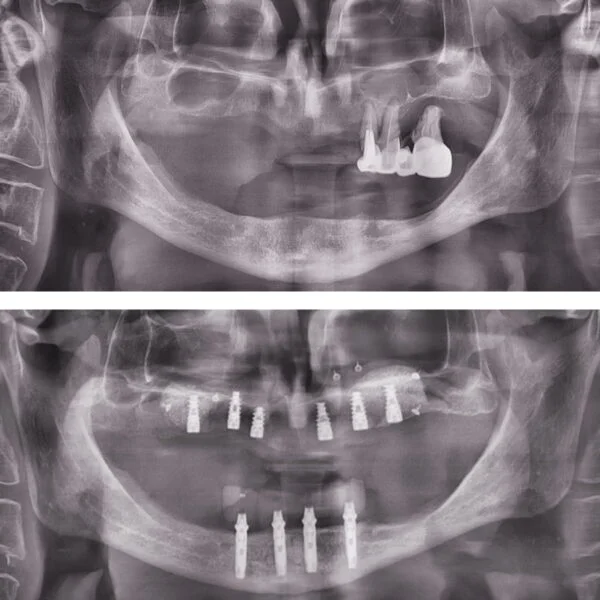 Proteza fixa pe implanturi - All on 4 / All on 6