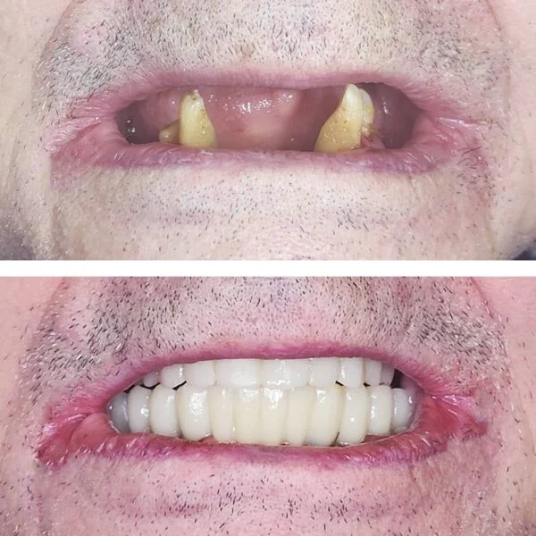 Proteza fixa pe implanturi - All on 4 / All on 6