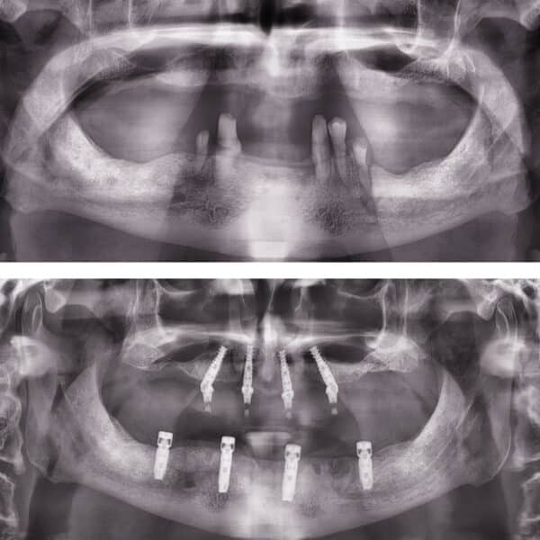 Proteza fixa pe implanturi - All on 4 / All on 6