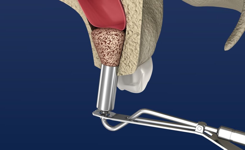 sinus lifting succes pentru implanturi dentare