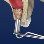 sinus lifting succes pentru implanturi dentare