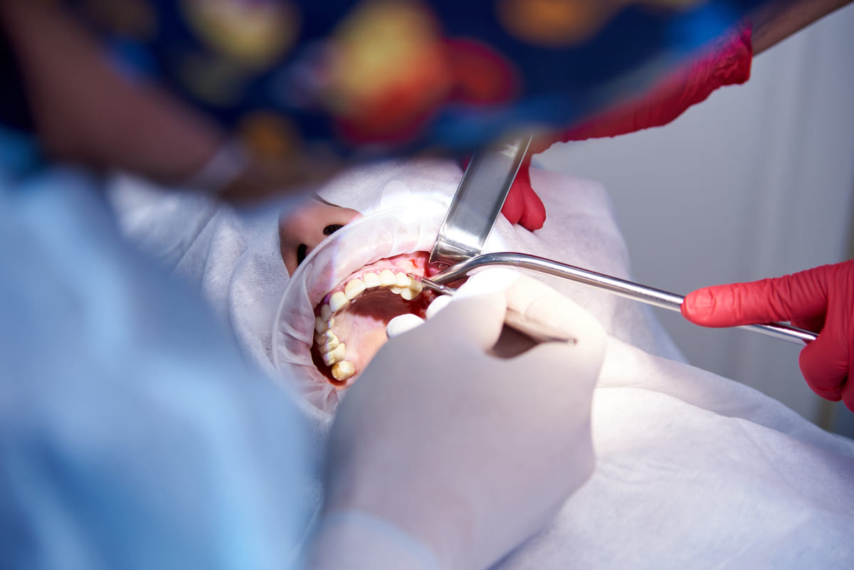 tehnici de interventie pentru sinus lifting