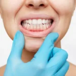 muscatura corecta cu tratament ortodontic