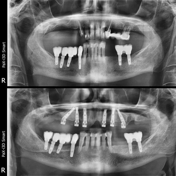 Proteza fixa pe implanturi - All on 4 / All on 6