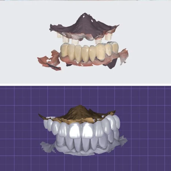 Proteza fixa pe implanturi - All on 4 / All on 6